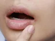 Є кілька факторів: Медики пояснили причину утворення “заїди” в куточках губ